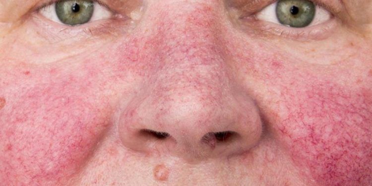 Lupus, síntomas en la piel