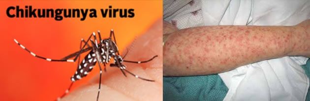 Efectos del virus chikungunya en el cuerpo