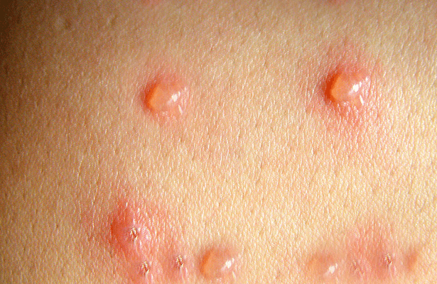 Ampollas es uno de los síntomas más frecuentes de la varicela