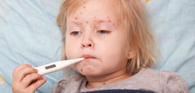 Varicela un síntoma más común en niños